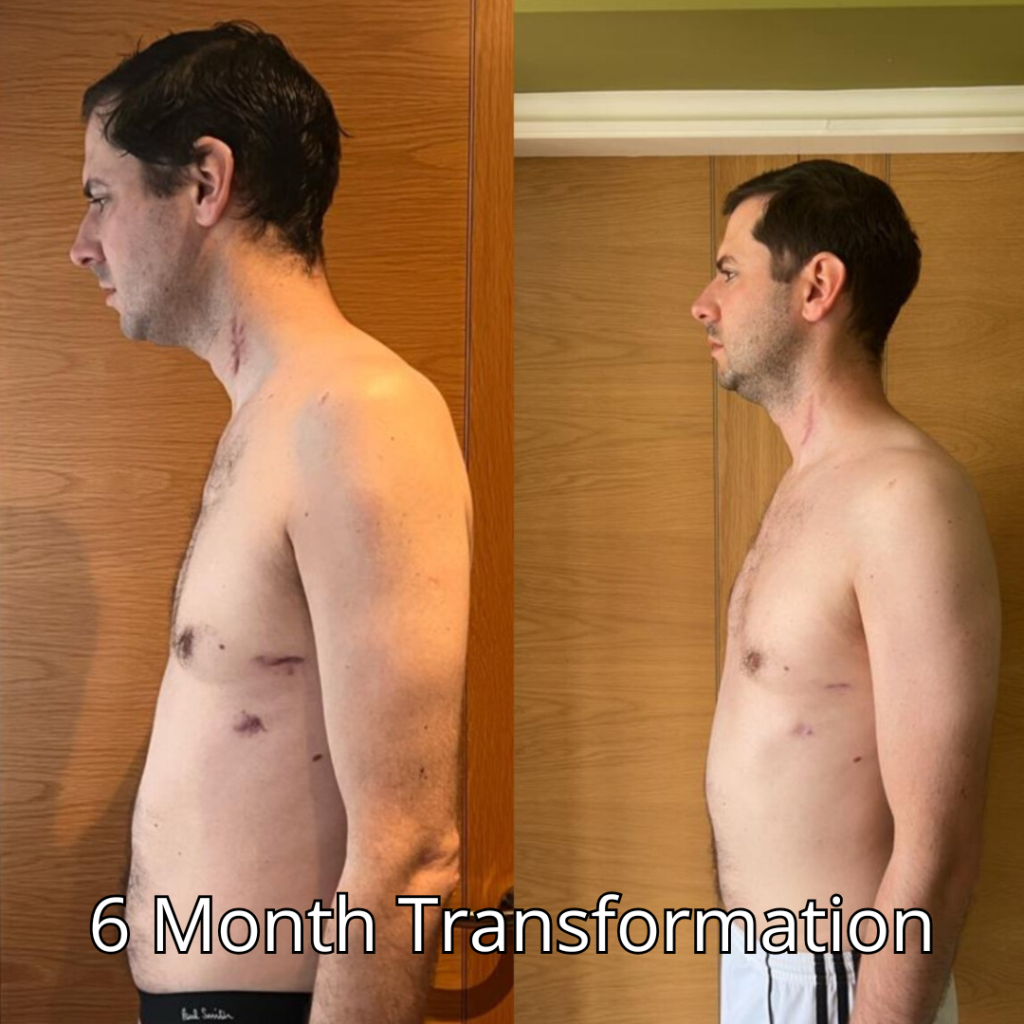 6 month rehab transformation PT Marbella